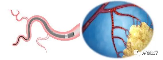 秀微微導管上海三甲醫院介入科試用案例分享